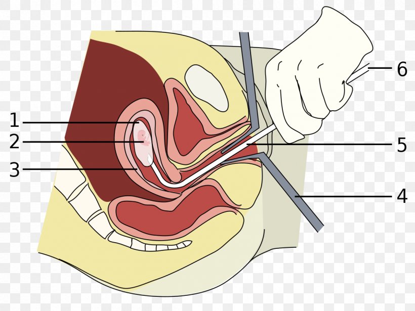 Vacuum Aspiration Miscarriage Abortion Surgery Dilation And Curettage, PNG, 1200x900px, Watercolor, Cartoon, Flower, Frame, Heart Download Free