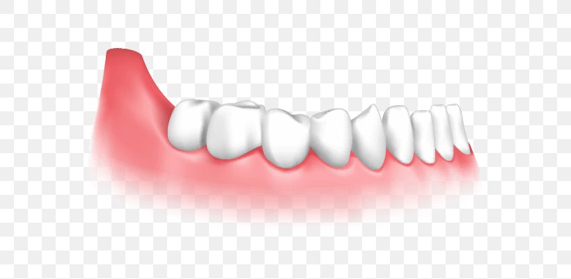 Dental Implant Dentistry Gingival Graft, PNG, 665x401px, Dental Implant, Cosmetic Dentistry, Crown, Dental Surgery, Dentist Download Free
