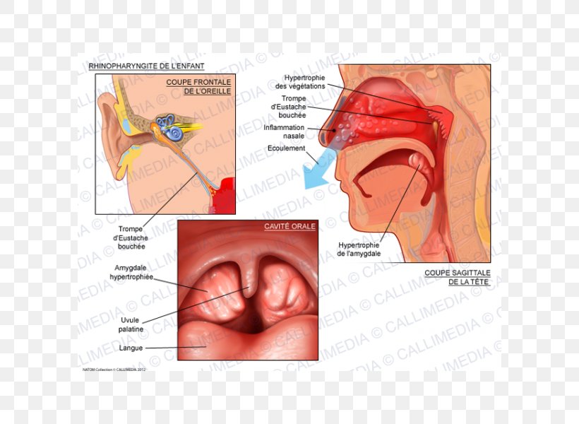 Tonsillitis Pharyngitis Infection Otorhinolaryngology, PNG, 600x600px, Watercolor, Cartoon, Flower, Frame, Heart Download Free