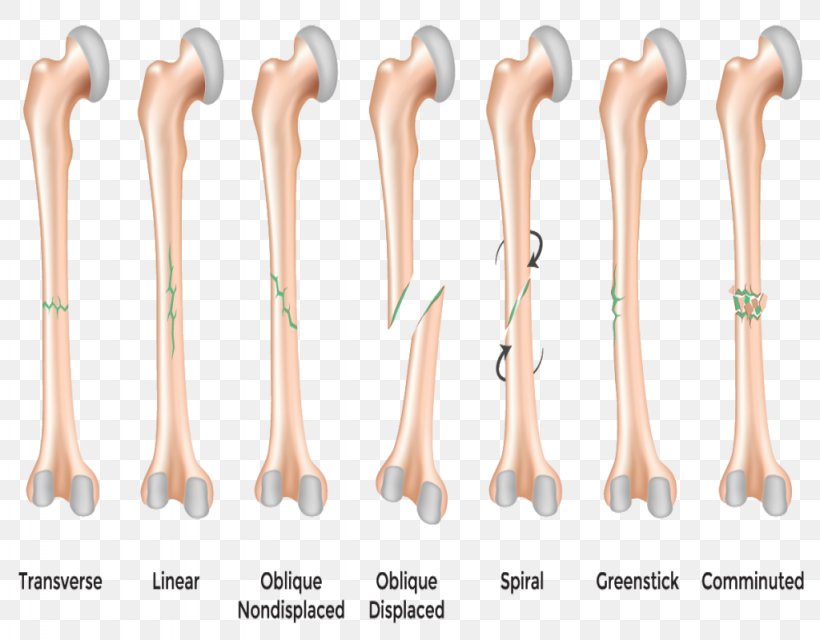 Bone Fracture Greenstick Fracture Stress Fracture Hip Fracture, PNG