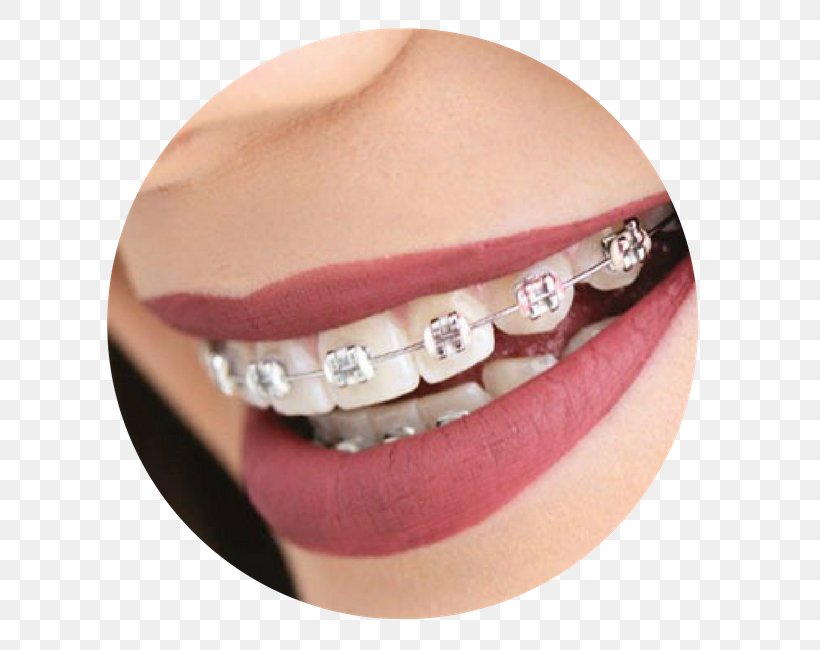 Dental Braces Tooth Dentistry Video, PNG, 700x650px, Dental Braces, Aesthetics, Chin, Dental Consonant, Dental Floss Download Free
