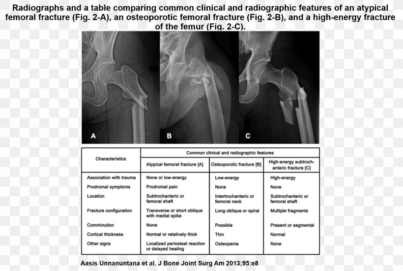 Femoral Fracture Osteoporosis Femur Bone Fracture Lisfranc Injury, PNG, 1584x1067px, Femoral Fracture, Arm, Bisphosphonate, Black And White, Bone Download Free