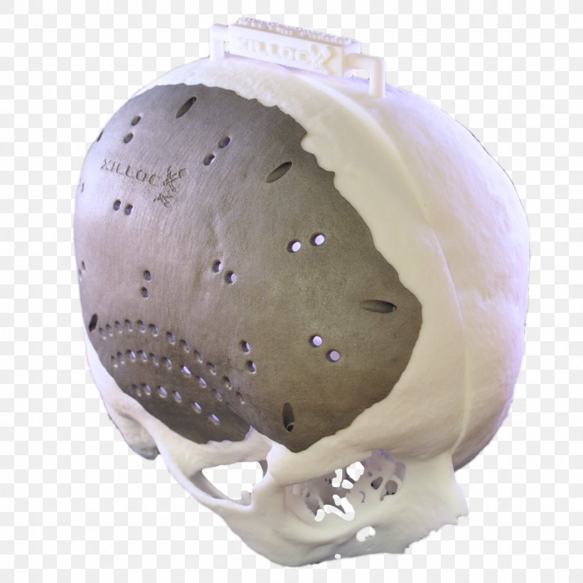 Skull Cranioplasty Brain Implant Titanium, PNG, 1074x1074px, Skull, Bone, Brain, Brain Implant, Cranioplasty Download Free