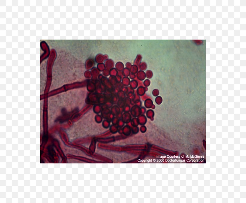 Malassezia Furfur Fungus Seborrheic Dermatitis Disease Skin, PNG, 553x676px, Fungus, Dandruff, Disease, Folliculitis, Magenta Download Free