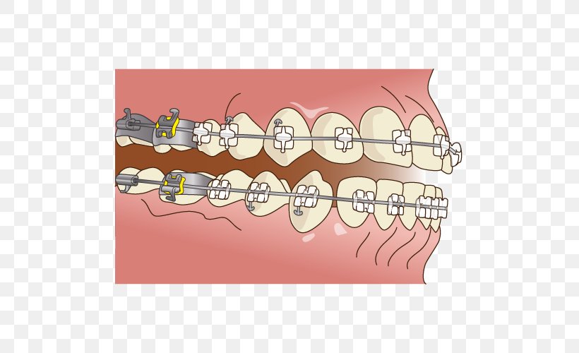 Dentistry 矯正歯科 Dental Braces, PNG, 500x500px, Watercolor, Cartoon, Flower, Frame, Heart Download Free