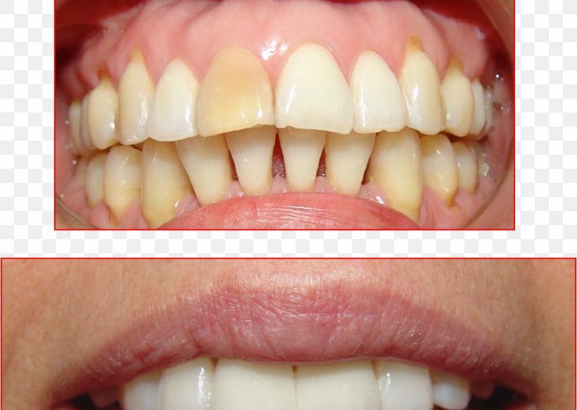 Tooth Ceramic Dental Restoration Resin Dentistry, PNG, 885x630px, Tooth, Ceramic, Cervical Vertebrae, Cosmetic Dentistry, Dental Restoration Download Free