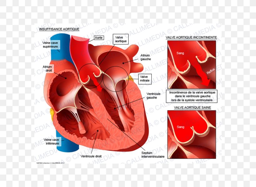 Aortic Insufficiency Valvular Aortic Stenosis Aortic Valve Aorta Mitral Insufficiency, PNG, 600x600px, Watercolor, Cartoon, Flower, Frame, Heart Download Free