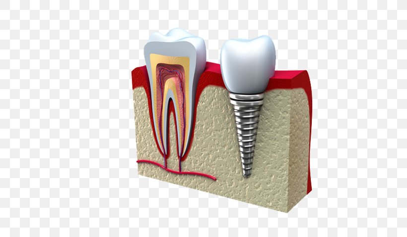 Dental Implant Dentistry Molar, PNG, 581x479px, Watercolor, Cartoon, Flower, Frame, Heart Download Free