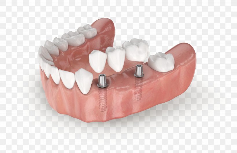 Tooth Jaw Dentures Dental Implant LASAK, PNG, 4000x2582px, Tooth, Abutment, Bone, Crown, Dental Implant Download Free