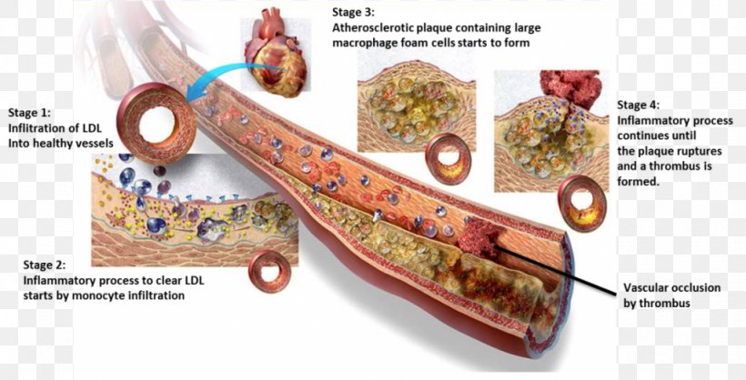 Arteriosclerosis Low-density Lipoprotein Foam Cell Atheroma Cardiovascular Disease, PNG, 1024x522px, Watercolor, Cartoon, Flower, Frame, Heart Download Free