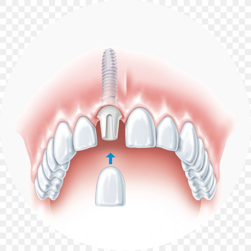 Dental Implant Dentistry Bridge, PNG, 920x920px, Watercolor, Cartoon, Flower, Frame, Heart Download Free