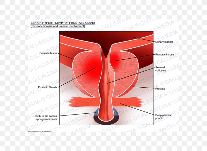 Benign Prostatic Hyperplasia Prostate Cancer Hypertrophy Tadalafil, PNG, 600x600px, Watercolor, Cartoon, Flower, Frame, Heart Download Free