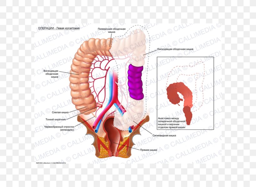 Rectum Colorectal Cancer Hemikolektomie Anatomy Colectomy, PNG, 600x600px, Watercolor, Cartoon, Flower, Frame, Heart Download Free