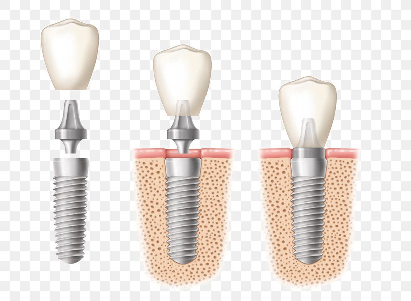 Dental Implant Dentistry Tooth, PNG, 724x600px, Dental Implant, Brush, Crown, Dental Restoration, Dental Surgery Download Free