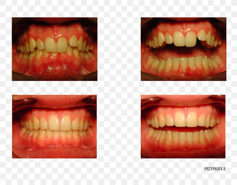 Tooth Camera Therapy Orthodontist Patient, PNG, 1024x800px, Tooth, Camera, Clinic, Close Up, Closeup Download Free
