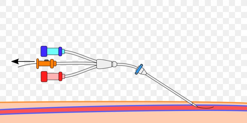 Seldinger Technique Central Venous Catheter Peripheral Venous Catheter Trocar, PNG, 1024x512px, Seldinger Technique, Angiography, Arterial Line, Artery, Cable Download Free