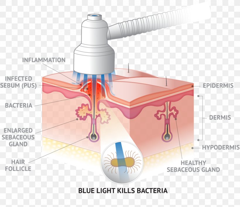 Quasar MD BLUE Light Therapy DTLA Derm Skin, PNG, 912x787px, Light, Acne, Blue, Hair Follicle, Joint Download Free