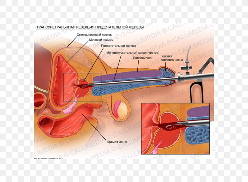 Transurethral Resection Of The Prostate Prostate Cancer Benign Prostatic Hyperplasia Surgery, PNG, 600x600px, Watercolor, Cartoon, Flower, Frame, Heart Download Free