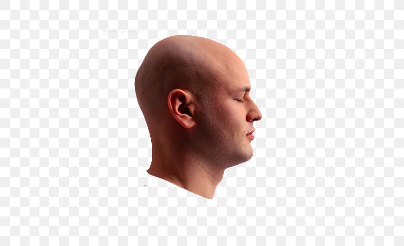 Botak Hair Loss Head Skin, PNG, 500x500px, Botak, Body, Cheek, Chin, Dandruff Download Free