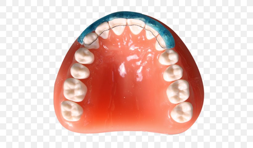 Digital Dentistry Diagnostic Wax-up CAD/CAM Dentistry Tooth, PNG, 640x480px, Dentistry, Brochure, Cadcam Dentistry, Clinic, Dental Implant Download Free