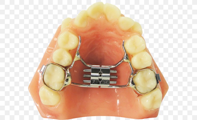 Tooth Orthodontic Technology Orthodontics Dentistry Dental Braces, PNG, 592x500px, Tooth, Bruxism, Crossbite, Dental Braces, Dental Laboratory Download Free