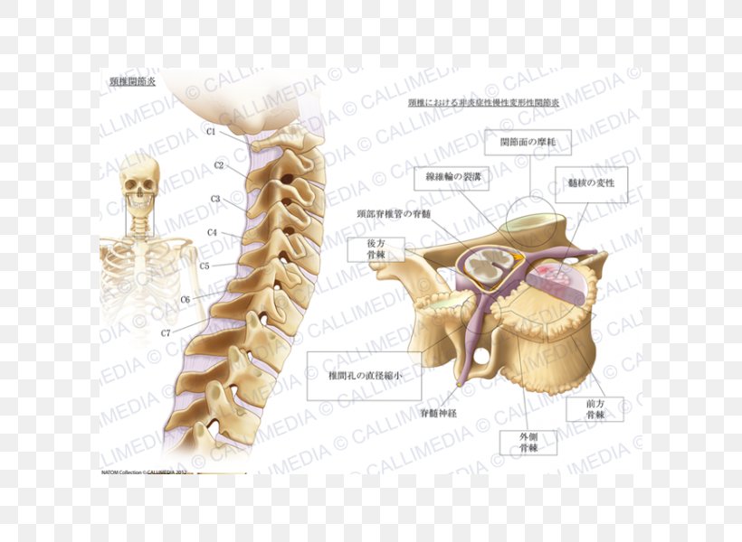 Cervical Osteoarthritis Cervical Vertebrae Pain, PNG, 600x600px, Watercolor, Cartoon, Flower, Frame, Heart Download Free