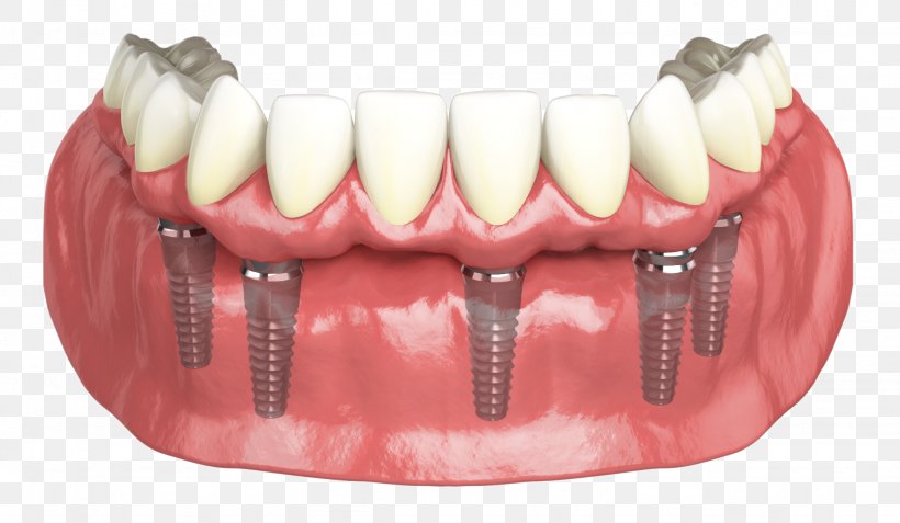 Hybridge Dental Implants Dentistry, PNG, 2049x1194px, Hybridge Dental Implants, Cosmetic Dentistry, Crown, Dental Implant, Dental Restoration Download Free