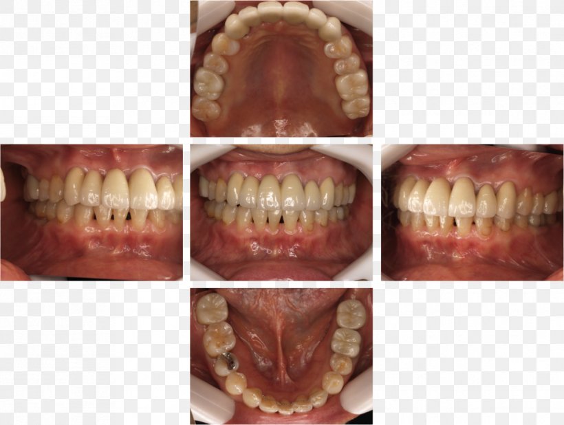 Dentist 矯正歯科 Therapy Dental Braces Jaw, PNG, 1243x938px, Dentist, Dental Braces, Dental Extraction, Dentistry, Express Train Download Free
