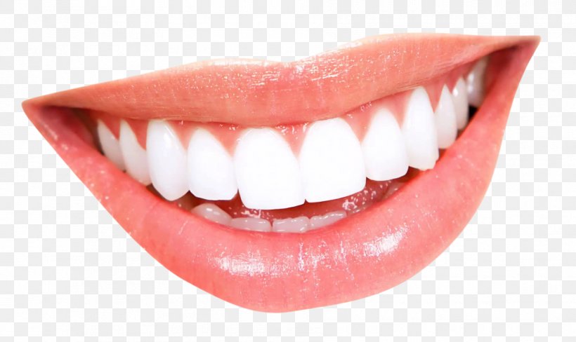 Smile Mouth Human Tooth, PNG, 1812x1080px, Tooth, Cosmetic Dentistry, Crown, Dental Braces, Dentistry Download Free
