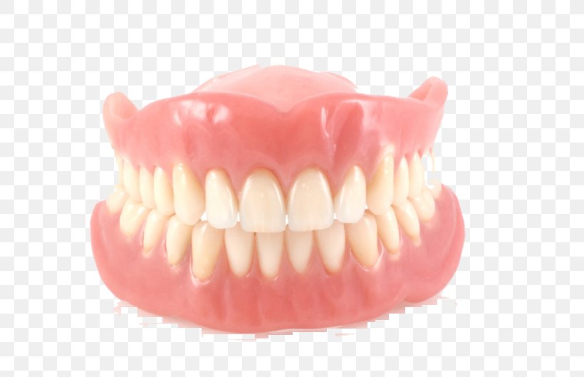 Dentures Removable Partial Denture Dentistry Dental Implant Dental Laboratory, PNG, 715x529px, Dentures, Bridge, Complete Dentures, Cosmetic Dentistry, Crown Download Free
