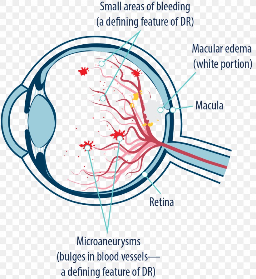 Macular Edema Diabetic Retinopathy Macula Of Retina Macular Degeneration Diabetes Mellitus, PNG, 941x1025px, Watercolor, Cartoon, Flower, Frame, Heart Download Free
