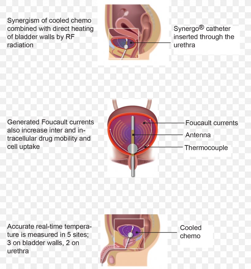 Therapy Bladder Cancer Mitomycin C Patient Disease, PNG, 1493x1600px, Watercolor, Cartoon, Flower, Frame, Heart Download Free