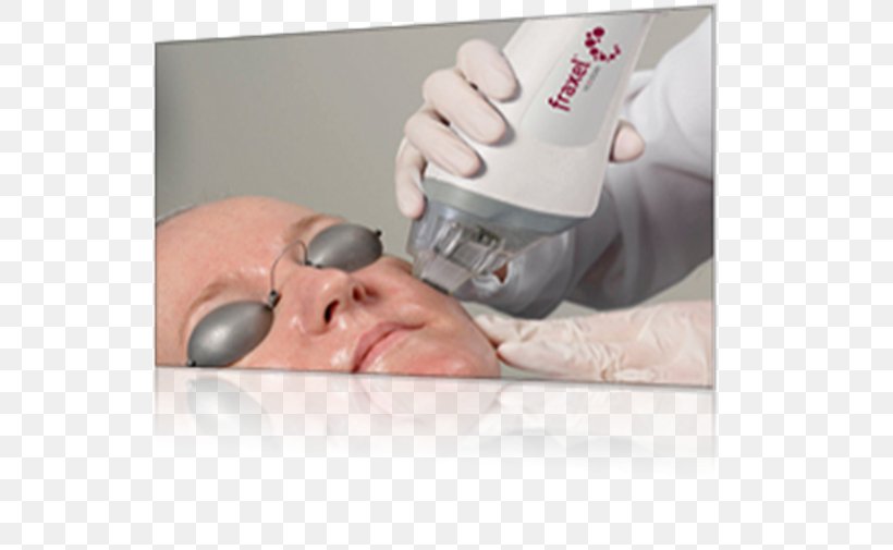 Fraxel Low-level Laser Therapy Low-level Laser Therapy Facial Rejuvenation, PNG, 576x505px, Fraxel, Chin, Cosmetics, Dermatology, Ear Download Free