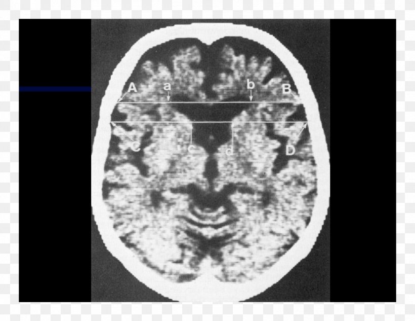Computed Tomography Brain White Font, PNG, 1584x1224px, Watercolor, Cartoon, Flower, Frame, Heart Download Free