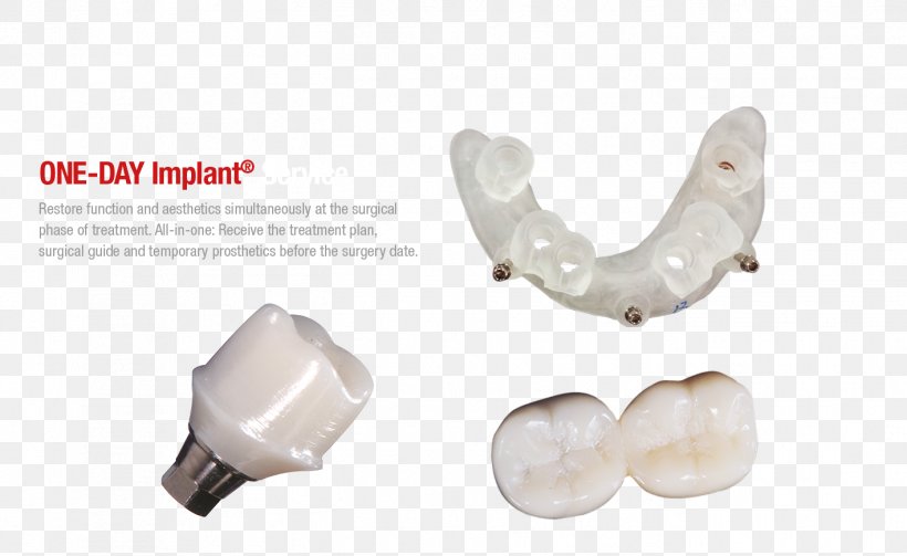Dental Implant Abutment Temporary Crown CAD/CAM Dentistry, PNG, 1417x870px, Dental Implant, Abutment, Cadcam Dentistry, Crown, Dentistry Download Free