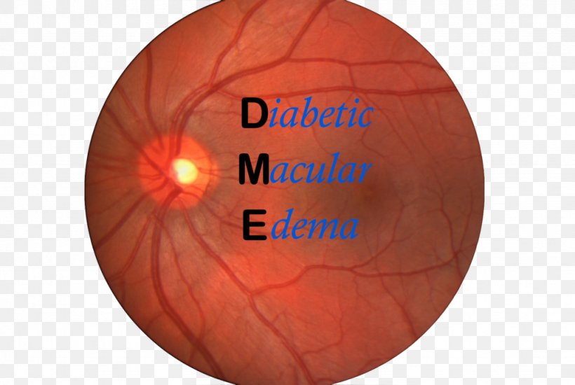 Macular Edema Macula Of Retina Diabetic Retinopathy, PNG, 1024x688px, Macular Edema, Diabetes Mellitus, Diabetic Retinopathy, Edema, Health Download Free