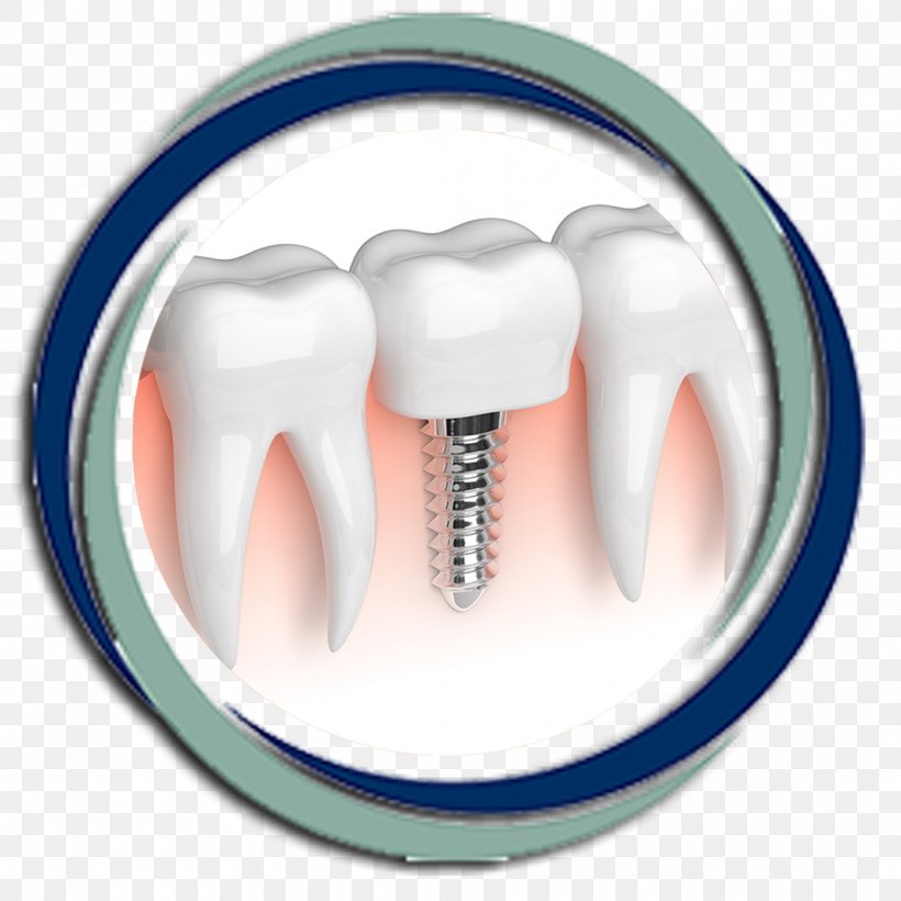 Dental Implant Dentistry Atlanta Center For Dental Health, PNG, 1060x1060px, Dental Implant, Bridge, Crown, Dental Restoration, Dentist Download Free