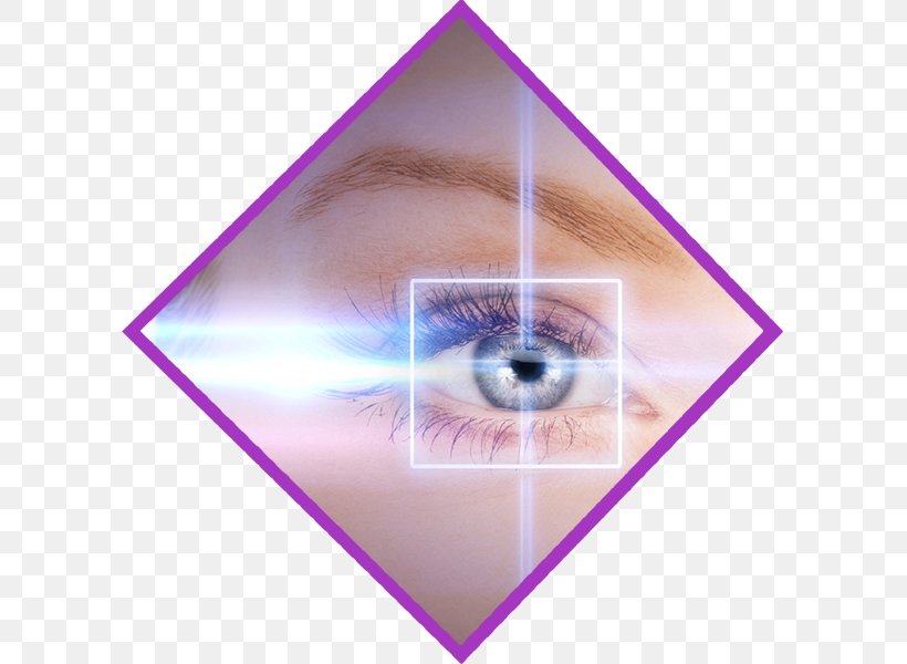 LASIK Eye Surgery Cataract, PNG, 600x600px, Lasik, Cataract, Cataract Surgery, Contact Lenses, Cornea Download Free