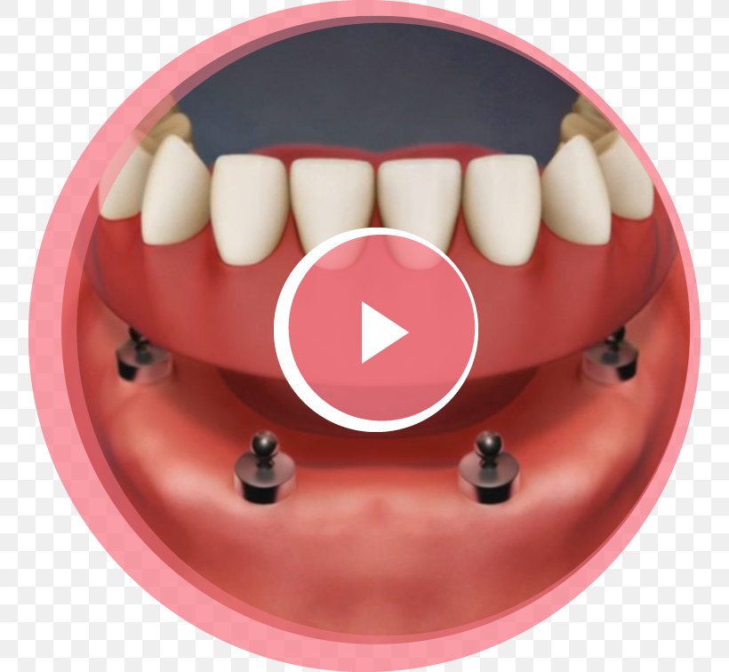 Tooth Dental Implant Dentures Removable Partial Denture, PNG, 756x756px, Watercolor, Cartoon, Flower, Frame, Heart Download Free