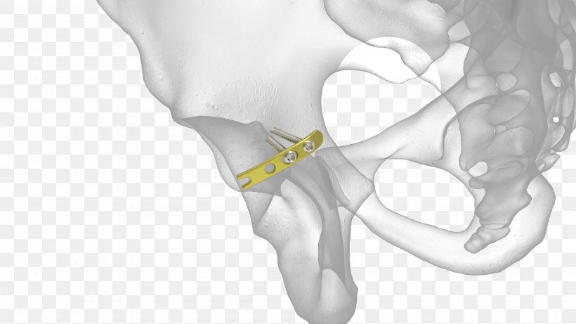 Bone Fracture Acetabulum Acetabular Fracture Radius Pelvic Fracture, PNG, 4000x2250px, Watercolor, Cartoon, Flower, Frame, Heart Download Free