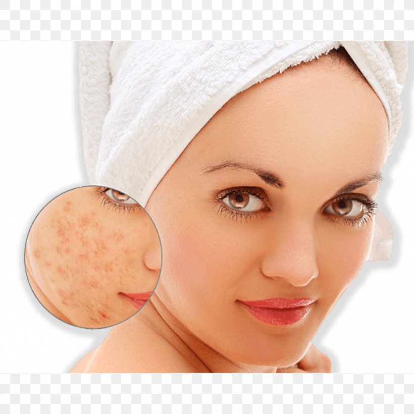 Scar Acne Pimple Dermatitis Skin, PNG, 1000x1000px, Scar, Acne, Beauty, Burn, Cause Download Free