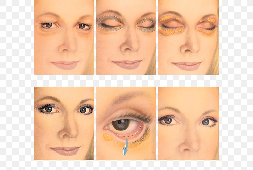 Blepharoplasty Eyelid Surgery Periorbital Puffiness, PNG, 600x550px, Blepharoplasty, Adipose Tissue, Beauty, Cheek, Chin Download Free