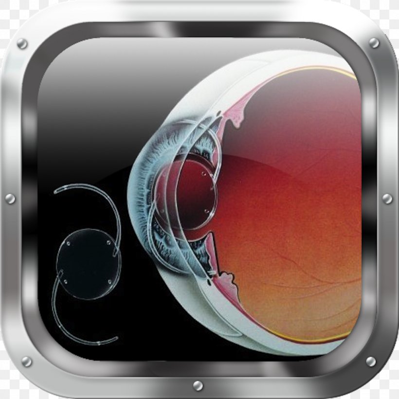 Intraocular Lens Retinal Detachment Cataract Surgery, PNG, 1024x1024px, Intraocular Lens, Anterior Chamber Of Eyeball, Audio, Cataract, Cataract Surgery Download Free