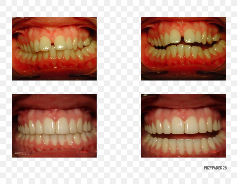 Orange Polska Tooth Close-up Therapy, PNG, 1024x800px, Orange, Close Up, Closeup, Cosmetic Dentistry, Jaw Download Free