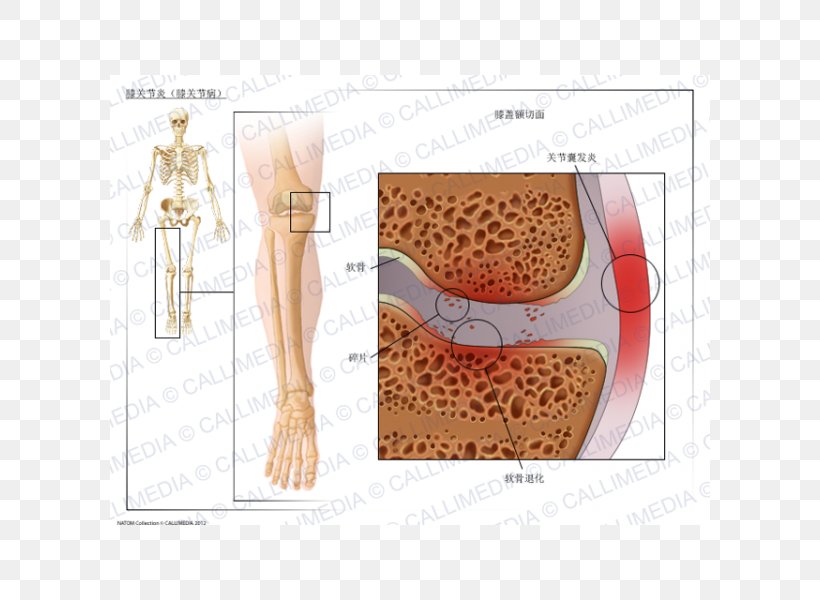 Knee Arthritis Knee Osteoarthritis, PNG, 600x600px, Watercolor, Cartoon, Flower, Frame, Heart Download Free