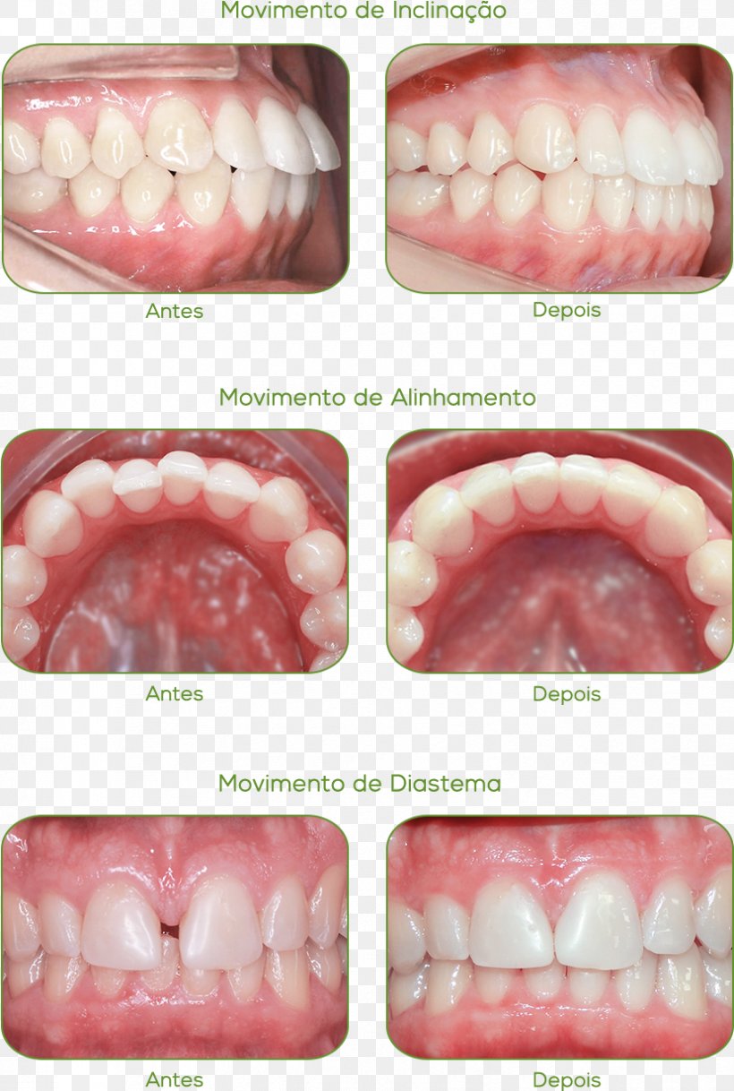 Case Report Jaw Orthodontics Health Acetate, PNG, 829x1232px, Case Report, Acetate, Beauty, Dentistry, Health Download Free