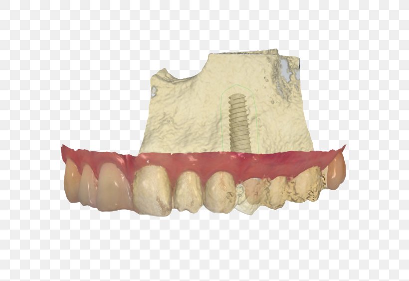 Dental Laboratory Dental Implant Prosthesis Dentistry, PNG, 641x563px, Dental Laboratory, Abutment, Computeraided Design, Dental Implant, Dental Technician Download Free
