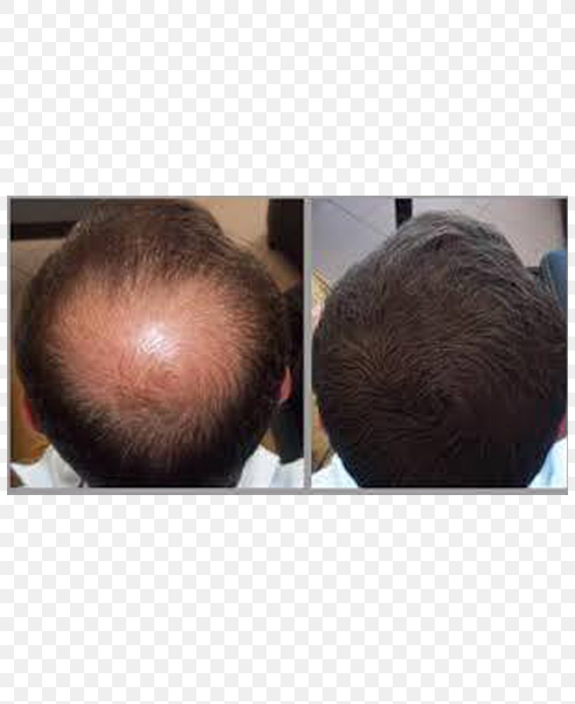Management Of Hair Loss Hair Care Human Hair Growth, PNG, 800x1004px, Hair Loss, Chin, Concealer, Ear, Face Powder Download Free