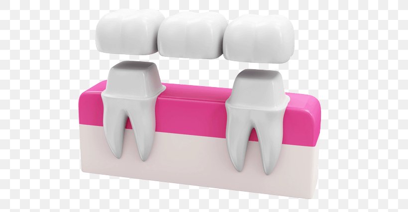 Bridge Dentistry Crown Dental Implant, PNG, 640x426px, Bridge, Abutment, Chair, Crown, Dental Implant Download Free