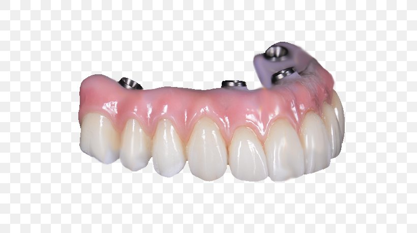Tooth All-on-4 Dentures Bridge Dental Implant, PNG, 586x458px, Tooth, Bridge, Ceramic, Crown, Dental Implant Download Free